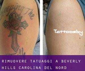 Rimuovere Tatuaggi a Beverly Hills (Carolina del Nord)