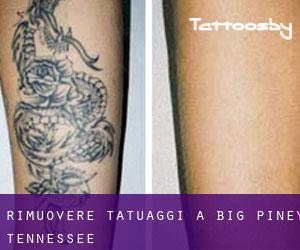 Rimuovere Tatuaggi a Big Piney (Tennessee)