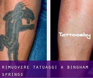 Rimuovere Tatuaggi a Bingham Springs