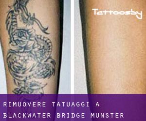 Rimuovere Tatuaggi a Blackwater Bridge (Munster)