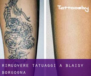 Rimuovere Tatuaggi a Blaisy (Borgogna)