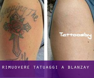 Rimuovere Tatuaggi a Blanzay