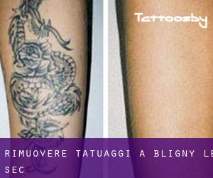 Rimuovere Tatuaggi a Bligny-le-Sec
