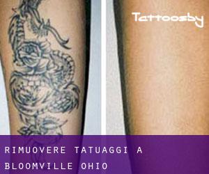 Rimuovere Tatuaggi a Bloomville (Ohio)