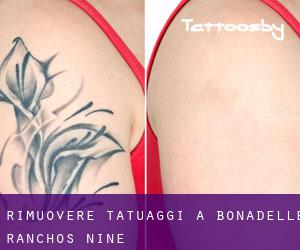 Rimuovere Tatuaggi a Bonadelle Ranchos Nine