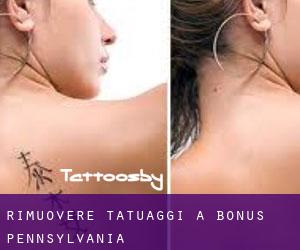 Rimuovere Tatuaggi a Bonus (Pennsylvania)