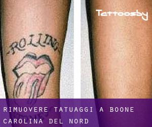 Rimuovere Tatuaggi a Boone (Carolina del Nord)