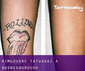 Rimuovere Tatuaggi a Boonesborough