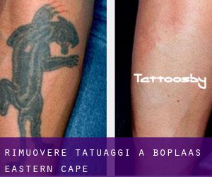 Rimuovere Tatuaggi a Boplaas (Eastern Cape)