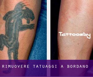 Rimuovere Tatuaggi a Bordano