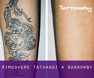 Rimuovere Tatuaggi a Borrowby
