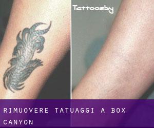 Rimuovere Tatuaggi a Box Canyon