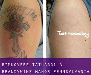 Rimuovere Tatuaggi a Brandywine Manor (Pennsylvania)