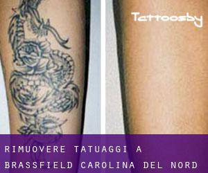 Rimuovere Tatuaggi a Brassfield (Carolina del Nord)