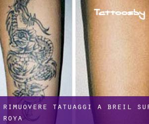 Rimuovere Tatuaggi a Breil-sur-Roya