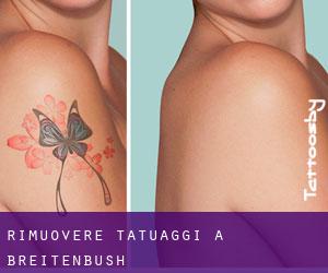 Rimuovere Tatuaggi a Breitenbush