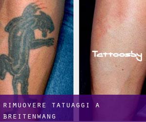 Rimuovere Tatuaggi a Breitenwang