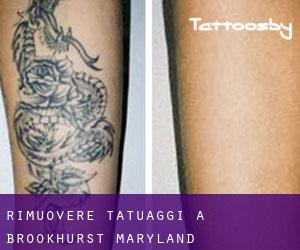 Rimuovere Tatuaggi a Brookhurst (Maryland)
