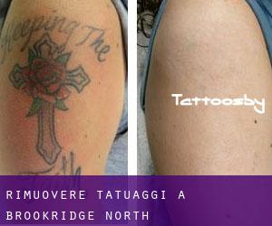 Rimuovere Tatuaggi a Brookridge North