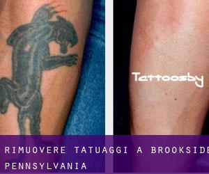 Rimuovere Tatuaggi a Brookside (Pennsylvania)