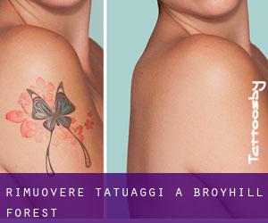 Rimuovere Tatuaggi a Broyhill Forest