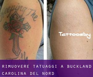 Rimuovere Tatuaggi a Buckland (Carolina del Nord)