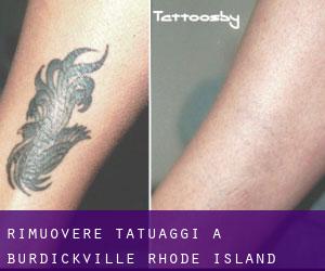 Rimuovere Tatuaggi a Burdickville (Rhode Island)