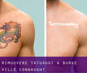 Rimuovere Tatuaggi a Burke Ville (Connaught)