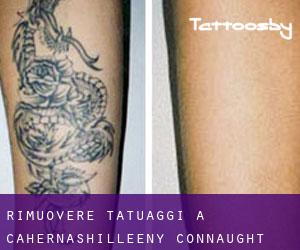 Rimuovere Tatuaggi a Cahernashilleeny (Connaught)