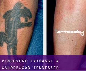 Rimuovere Tatuaggi a Calderwood (Tennessee)
