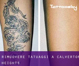 Rimuovere Tatuaggi a Calverton Heights