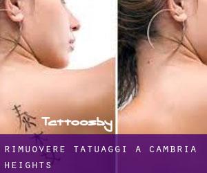 Rimuovere Tatuaggi a Cambria Heights