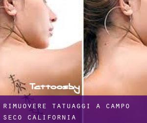 Rimuovere Tatuaggi a Campo Seco (California)