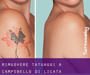 Rimuovere Tatuaggi a Campobello di Licata