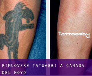 Rimuovere Tatuaggi a Cañada del Hoyo