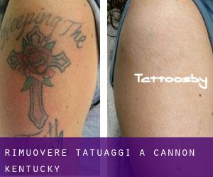 Rimuovere Tatuaggi a Cannon (Kentucky)