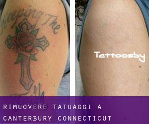 Rimuovere Tatuaggi a Canterbury (Connecticut)