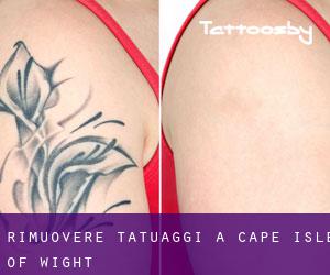 Rimuovere Tatuaggi a Cape Isle of Wight