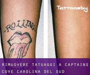 Rimuovere Tatuaggi a Captains Cove (Carolina del Sud)