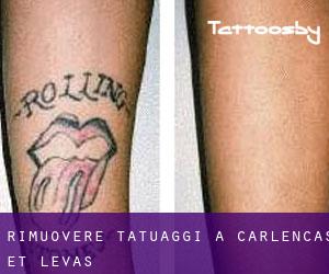 Rimuovere Tatuaggi a Carlencas-et-Levas