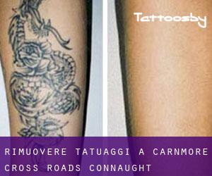 Rimuovere Tatuaggi a Carnmore Cross Roads (Connaught)