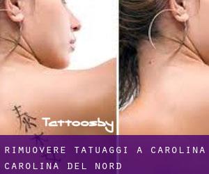 Rimuovere Tatuaggi a Carolina (Carolina del Nord)