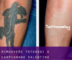 Rimuovere Tatuaggi a Carpignano Salentino