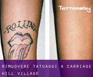 Rimuovere Tatuaggi a Carriage Hill Village