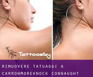 Rimuovere Tatuaggi a Carrowmoreknock (Connaught)