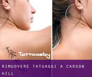 Rimuovere Tatuaggi a Carson Hill