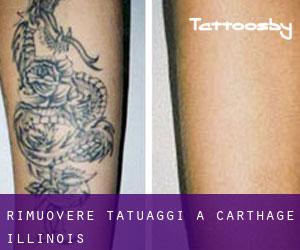 Rimuovere Tatuaggi a Carthage (Illinois)
