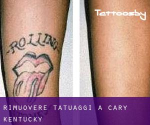 Rimuovere Tatuaggi a Cary (Kentucky)