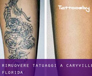 Rimuovere Tatuaggi a Caryville (Florida)