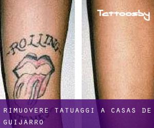 Rimuovere Tatuaggi a Casas de Guijarro